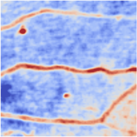 microaneurysms